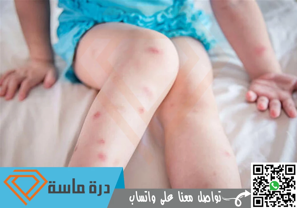 شركة مكافحة بق الفراش بخميس مشيط 🐞 | 0593428144 | إبادة البق 62 Bed bug control in Khamis Mushait 02